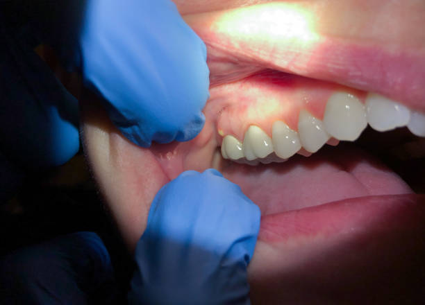 Best Broken or Cracked Tooth Emergency Dentist in Seeley Lake, MT